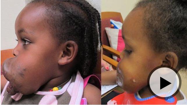 Ethiopian Girl, 4, Is Brought to U.S. for Life-Changing Surgery